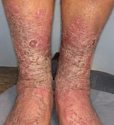 Skin before treatment