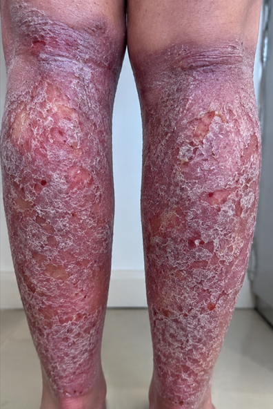 Skin before treatment