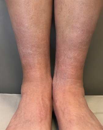Skin after treatment